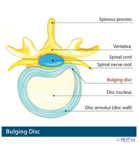 Can a Bulging Disc Be Treated Through Surgery? - South Florida