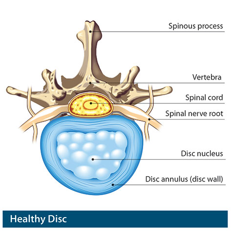 healthy disc