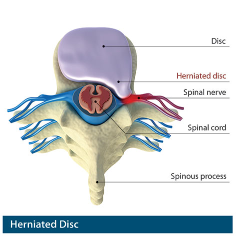 herniated