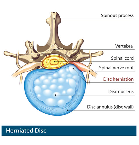 herniated disc treatment