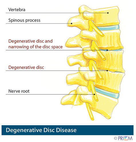 What Is Degenerative Disc Disease? - Orthopedic & Sports Medicine