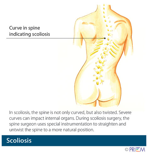 Scoliosis