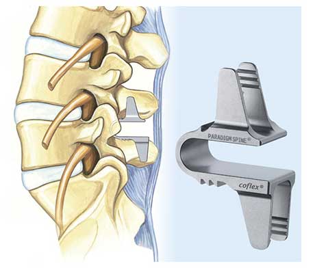 Coflex – An Alternative to Spinal Fusion at Northwest Florida Spine